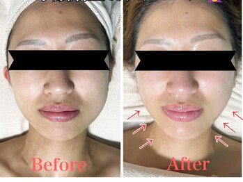 ウルオイ 海老名(URUoi)/小顔矯正 before after