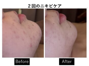 ナチュラーレ 京都四条烏丸店(Naturale)/美肌ニキビケア小顔フェイシャル