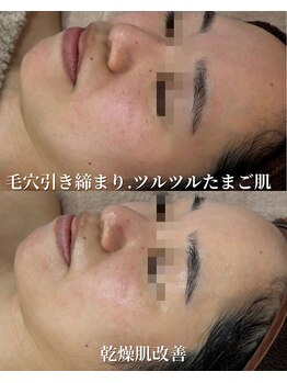 ココリール/乾燥肌　赤み