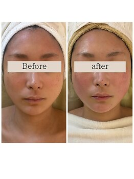 ミピマムマール(Mipimam Maaru)/【コルギ】肌質改善