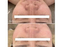 ミエル 神戸店(Miel)/ハーブトリートメント