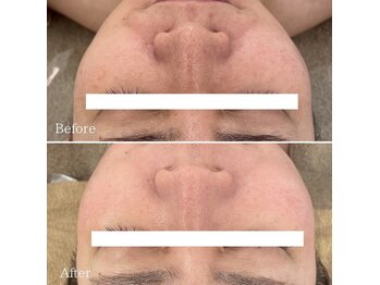 ミエル 神戸店(Miel)/ハーブトリートメント