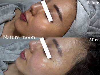 ナチュールムーン(Nature moon.)/ハーブピーリング