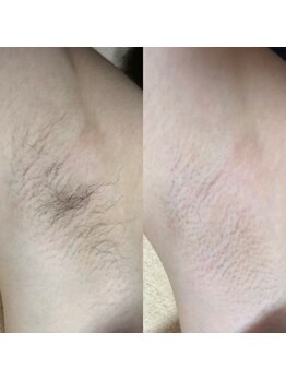 ミーフォレスト(Mi Forest)/