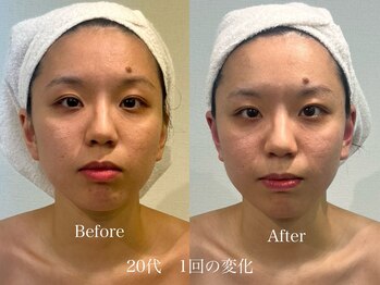 グランディールスイート(GRANDIR suite)/FACE MAKER施術結果