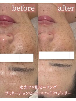 アディクトウラ(Addict'ula)/ラミネーションピール