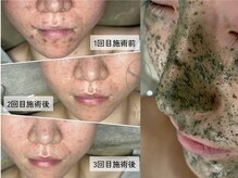 ソアスキン(SOAskin)の雰囲気（大人気の【ハーブピーリング】で肌質改善!ニキビケア・毛穴ケア）