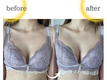 ラジュワード(lajward)の写真/【1度の施術でここまで溢れる】もっちり、本来の位置に♪ワンサイズアップでふわふわバストへ