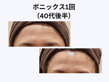 アユアラングレース/40歳後半・1回/額の横シワ消失!