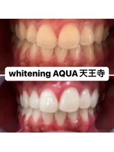 アクア 天王寺店(AQUA)/セルフホワイトニング効果