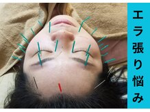 リノ(lino)/美容鍼