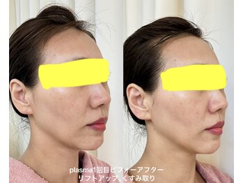 エレガンテ(ELEGANTE)/最新プラズマシャワー1回目