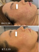 オレアグリーン 岡崎(OLEA green)/小顔矯正＋ハーブの変化(小顔)