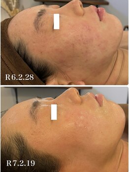 オレアグリーン 岡崎(OLEA green)/小顔矯正+ハーブの変化(小顔)