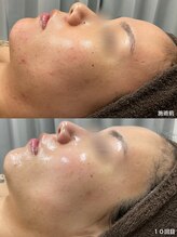 チェルト 鈴鹿店(CERTO)/REVIハーブピーリング