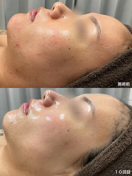 チェルト 鈴鹿店(CERTO)/REVIハーブピーリング