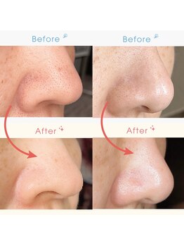 トリプルエー(AAA)/毛穴ケア☆イチゴ鼻スッキリ☆