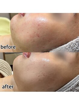 カノン(Kanon)/【ニキビケア】アクアダーマ5回