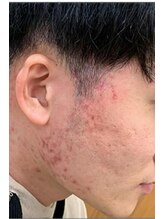 リベル 名古屋(Lebelle:)/名古屋　ハーブピーリング