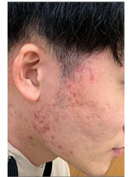 リベル 名古屋(Lebelle:)/名古屋 ハーブピーリング