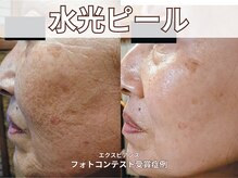 ポレ サロ(pore salo)/【水光ピール・肌管理】