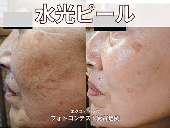 ポレ サロ(pore salo)/【水光ピール・肌管理】