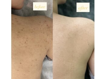 ソアン(Soin)/ボディハーブピーリング