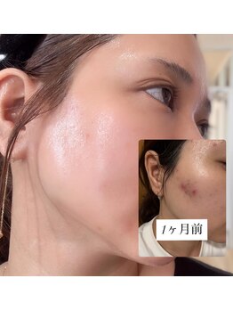 ワイスタイル(Ystyle)の写真/男女問わず施術OK！肌荒れ・毛穴・いちご鼻・皮脂のお悩みを解消し、透明感あふれる理想の肌へ☆
