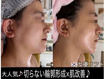 アルページュ(Arpege)の写真/韓国人気★エステ版チタニウムリフト【小顔輪郭×高ハリ×色白シミケア×毛穴レス】一度で叶う欲張り美容