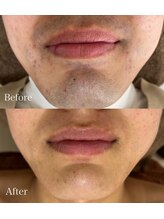 エース(ACE.)/脱毛は"身だしなみ"！