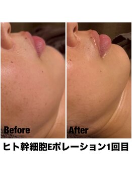 Sスタイルスタジオ 福岡天神/エレクトロポレーション1回目