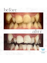 ホワイトニングショップ 広島店(WHITENING SHOP)/【ホワイトニング】Before After