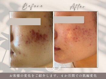 碧(ao)/肌質改善・ニキビ・肌荒れ