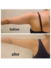 クリニカルエステ イーズ あべのキューズタウン店/【レモンボトル】で華奢な二の腕