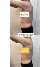 エレーヴ(Eleve)/痩身50代男性