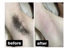メンズ脱毛ジャパン 南小倉駅前店(メンズ脱毛JAPAN)/【Before＆After】脇脱毛