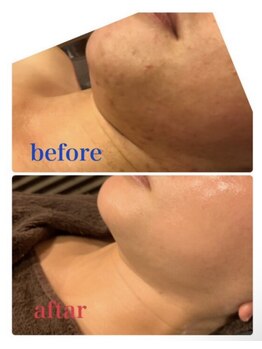 小顔 ツヤ肌/毛穴くすみ乾燥様々な肌悩みへ