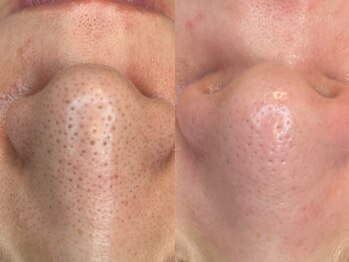 ヴィーヴ 京橋(vive)/【韓国式3D毛穴洗浄】