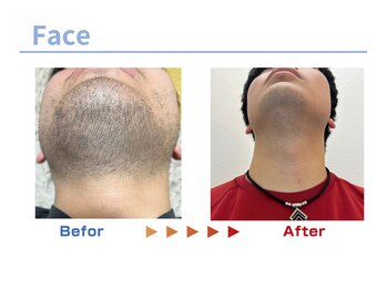 キングスサロン 熊本/熊本髭脱毛ビフォーアフター