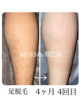 ミスターアンドミス 四ツ橋 堀江店(Mr.&Ms.)/メンズ足脱毛