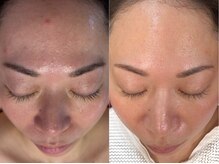 ルミア(LUMIA)/年齢肌＆肌トラブル改善を即実感