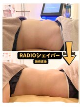 チェイン オブ フラワー(Chain Of Flower)/【RADIOシェイパー】1回での変化