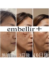 アンベリールプラス(embellir+)/光フォトはは毛穴にも特化