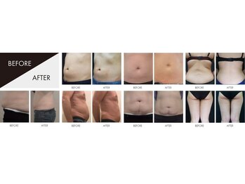 クライオ360(Cryo360)/脂肪冷却ビフォーアフター