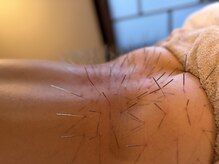 ハリドコロケン(KEN)/激しい腰痛も再発しにくくなる