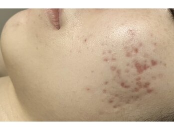 アンドユー ヨコハマ(&U Yokohama)/リベルハーブピーリング前