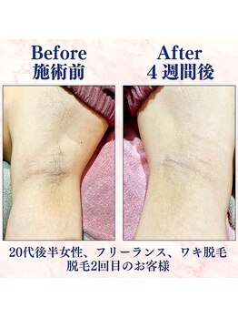 カラフル(caratful)/わき脱毛 Before After 