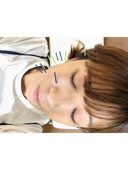 鍼灸施術を受けたい