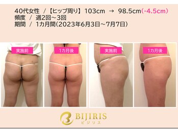 キングスサロン 熊本/美尻イスビフォーアフター