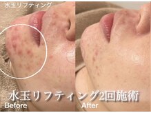 サロンヴェアリー 広尾(salon vary)の雰囲気（繰り返す悩みに水玉リフティング。お急ぎでしたらハーブとが◎）